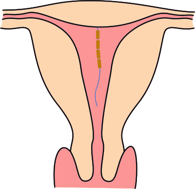 What does GyneFix look like?